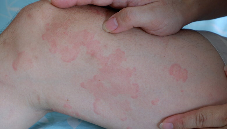 Atrito entre as pernas: como evitar e tratar as assaduras na parte interna da coxa