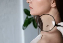 Raios UV causam 83% dos casos de melanoma no mundo, alerta OMS