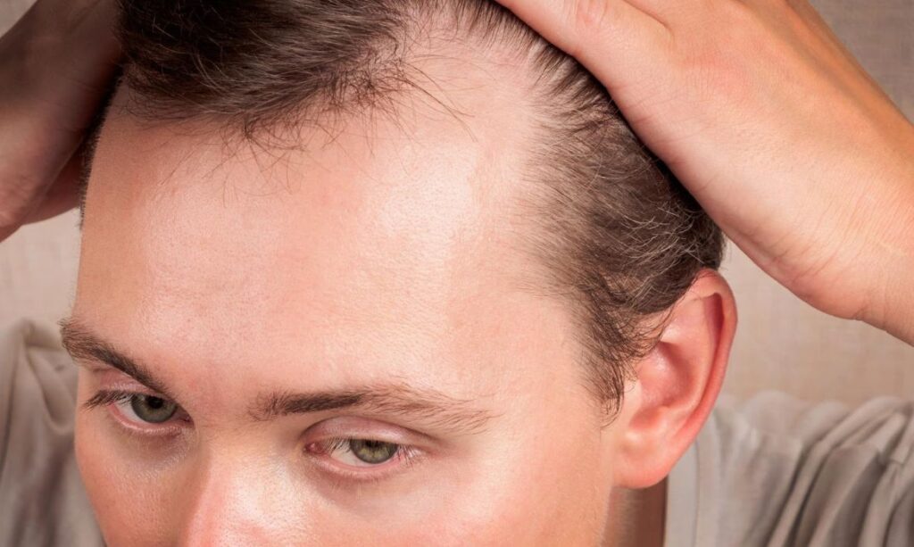 DHT: o hormônio da calvície