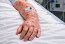 São Paulo registra 44 casos confirmados de mpox em 2026, diz Secretaria da Saúde