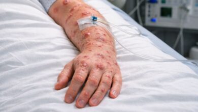 São Paulo registra 44 casos confirmados de mpox em 2026, diz Secretaria da Saúde