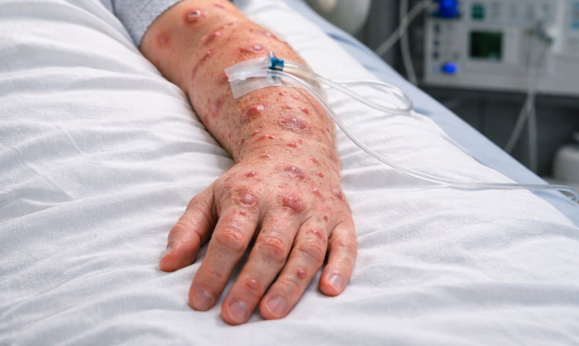 So Paulo registra 44 casos confirmados de mpox em 2026 diz Secretaria da Sade